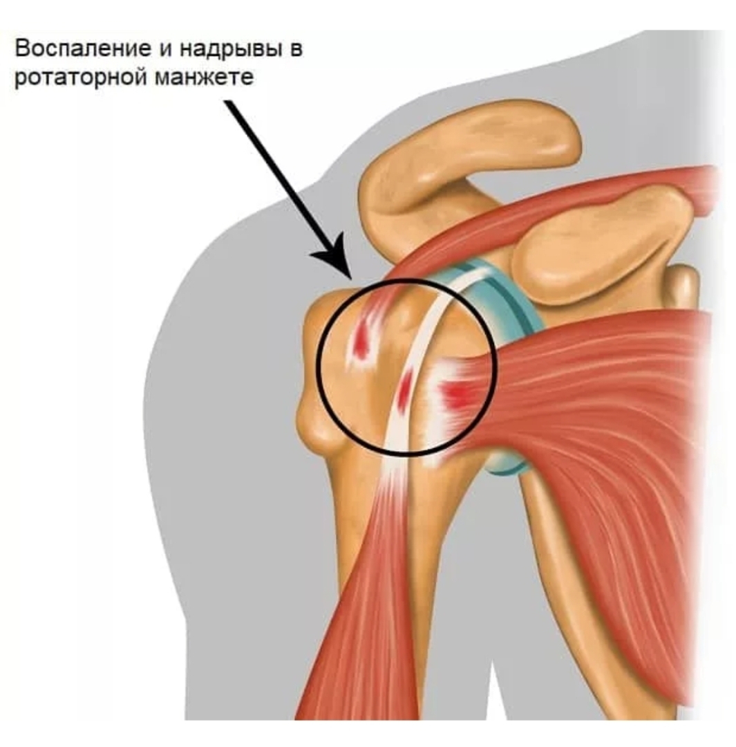 Ротаторная манжета плечевого сустава упражнения