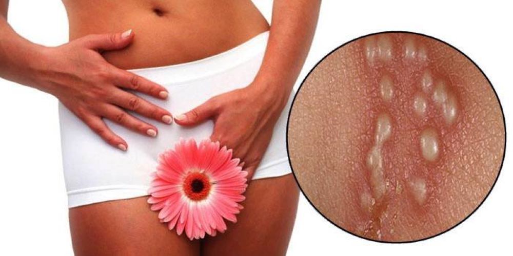 Генитальный герпес – бессимптомная передача инфекции