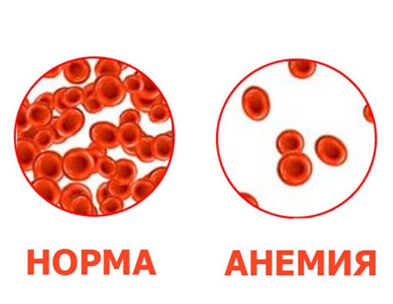 Диагностика анемии картинки