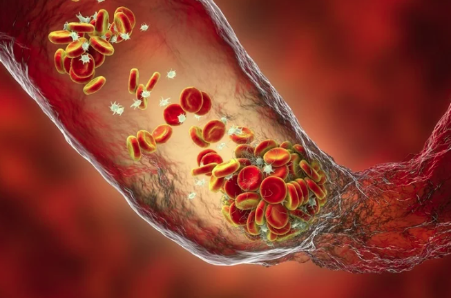 Рандомизированное исследование препарата для разжижения крови после тяжелой формы COVID-19 для предотвращения тромбообразования