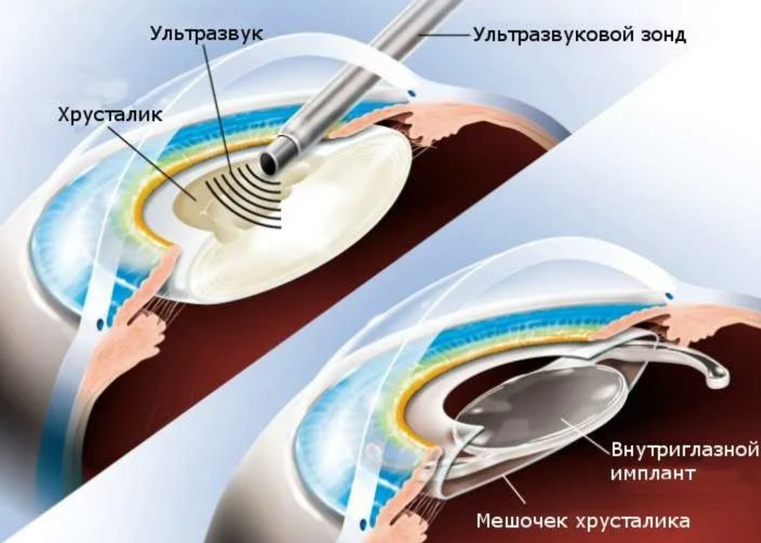 Искусственный хрусталик глаза фото как выглядит