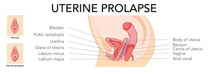 Женщина на TikTok сказала, что ее матка вышла из влагалища после того, как она пукнула, поэтому мы поговорили с врачом