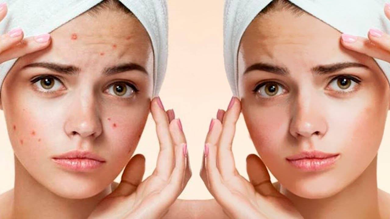 Как справиться с прыщами на лице самостоятельно