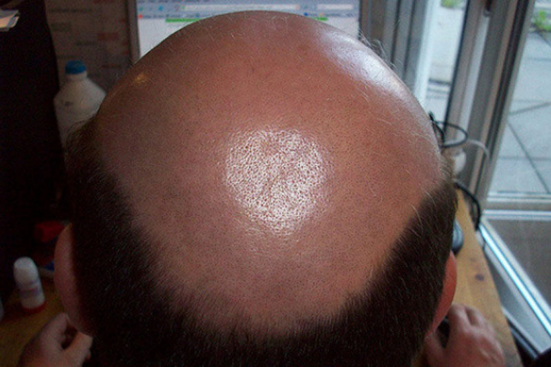 Искусство грациозно лысеть