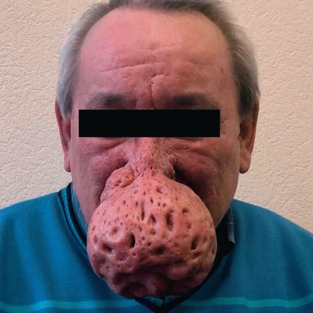 Это редкое заболевание кожи носа, которое может вызывать ужас у тех, кто столкнулся с ним.
