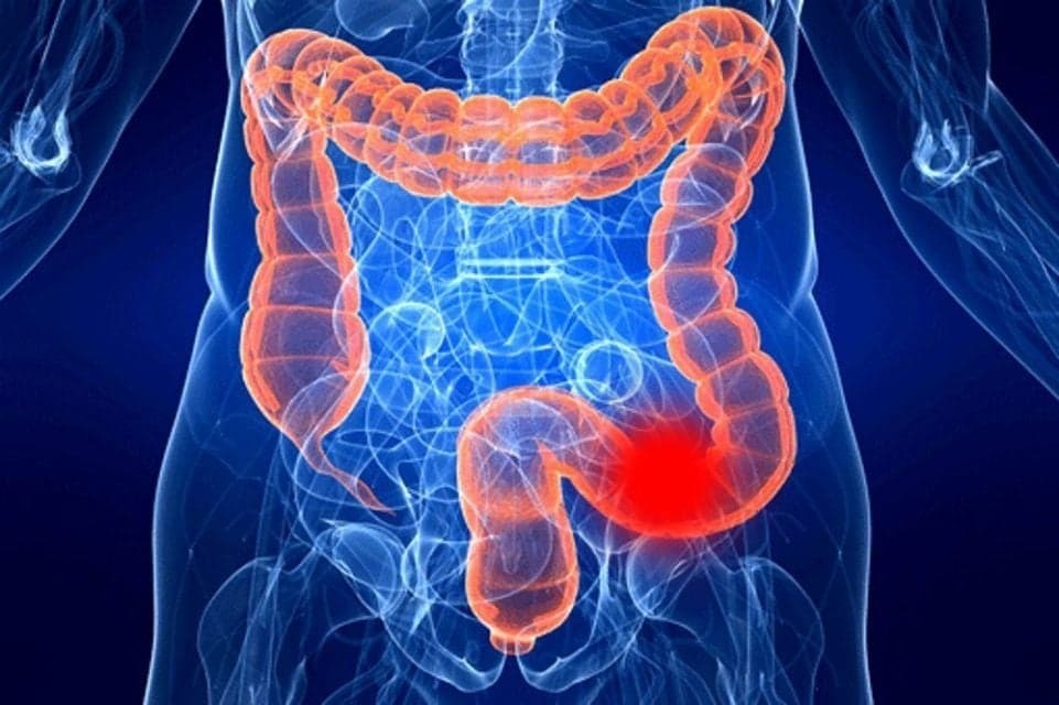 Вот 4 самых ранних признака рака толстой кишки у молодых взрослых, показало новое исследование