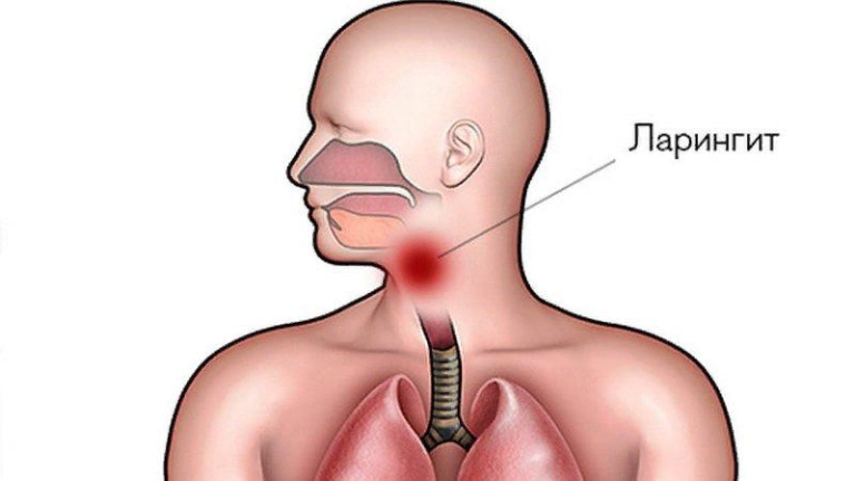 Ларингит - лечение народными средствами