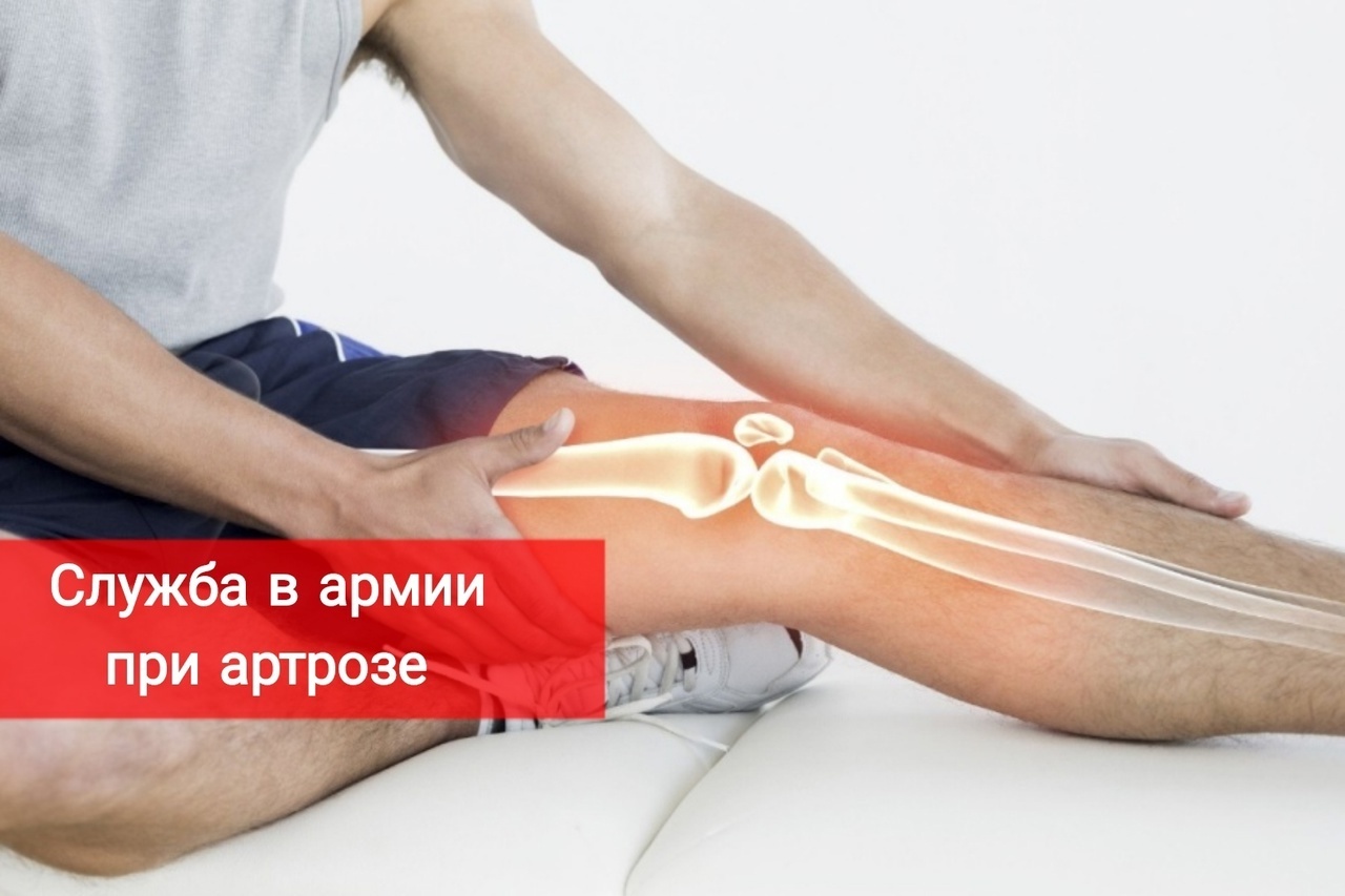 Артроз какой стадии освободит от службы в армии
