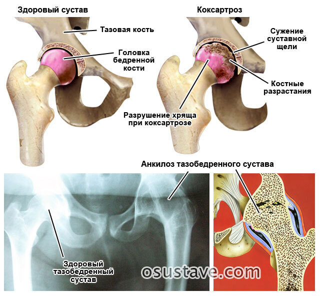 Где болит при коксартрозе фото