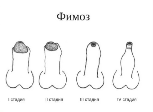 Фимоз у детей - причины, симптомы, лечение фимоза у ребенка