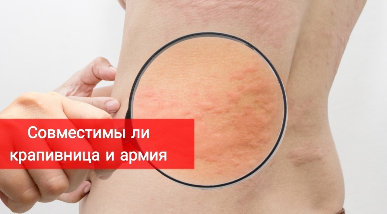 Совместимы ли крапивница и армия
