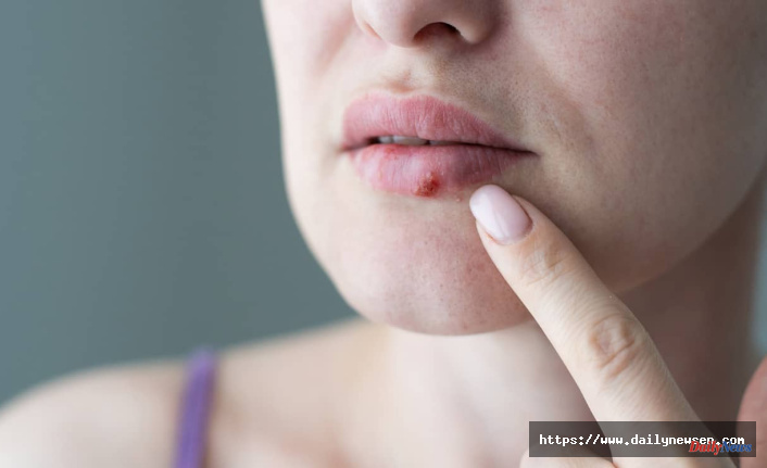 12+ Эфирных масел от герпеса | польза и применение.