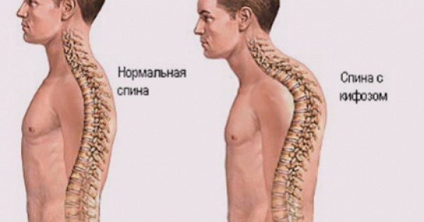 Служба в армии при кифозе