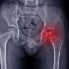 Болезнь Пертеса: симптомы, лечение и прогноз