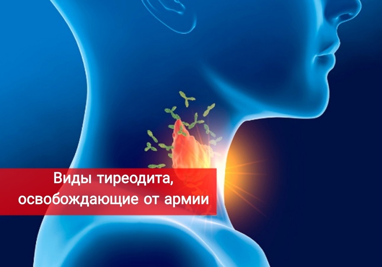 Виды тиреодита, освобождающие от службы в армии