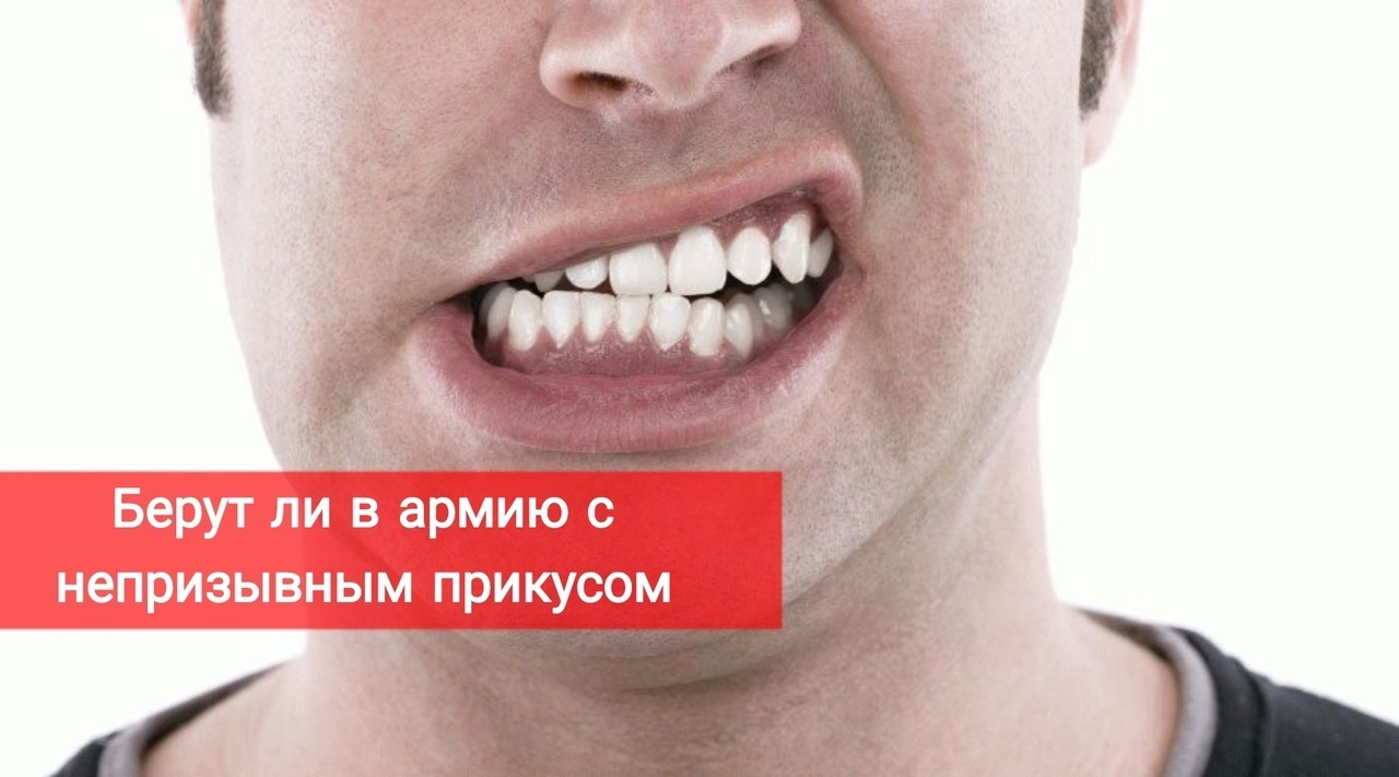 Берут ли в армию с неправильным прикусом