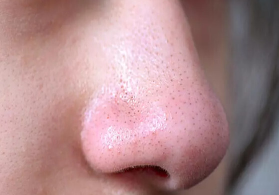 Методы, которые спасают от угрей. Простое средство доступное каждому