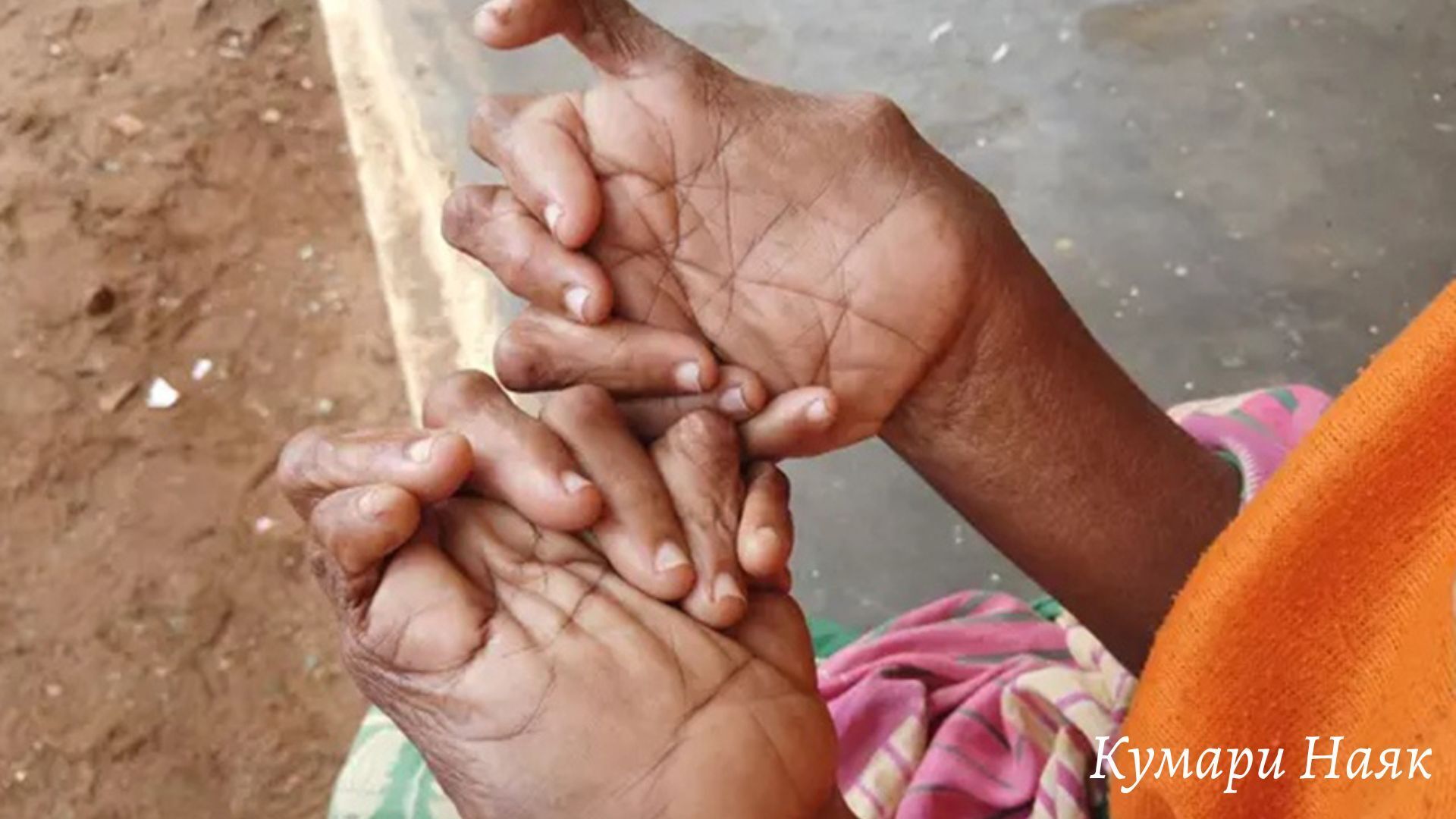 "Пальцы судьбы: Жизненный путь Кумари Наяк с исключительным количеством пальцев"