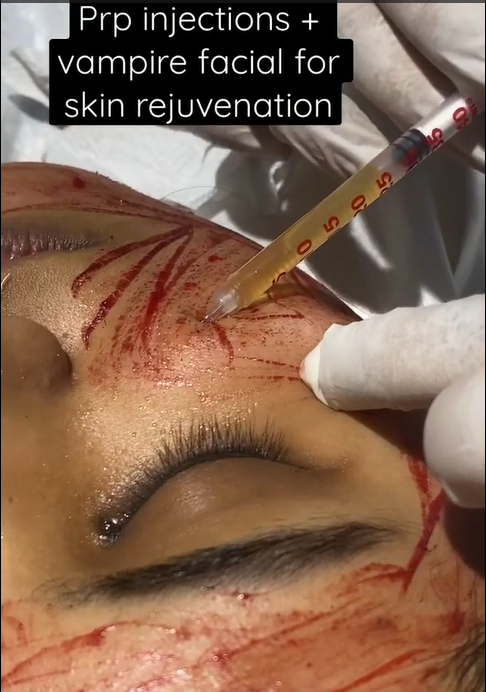 "ВАМПИРСКИЕ ПРОЦЕДУРЫ" (PRP) - риск ВИЧ-инфекции! Лечения травм !
