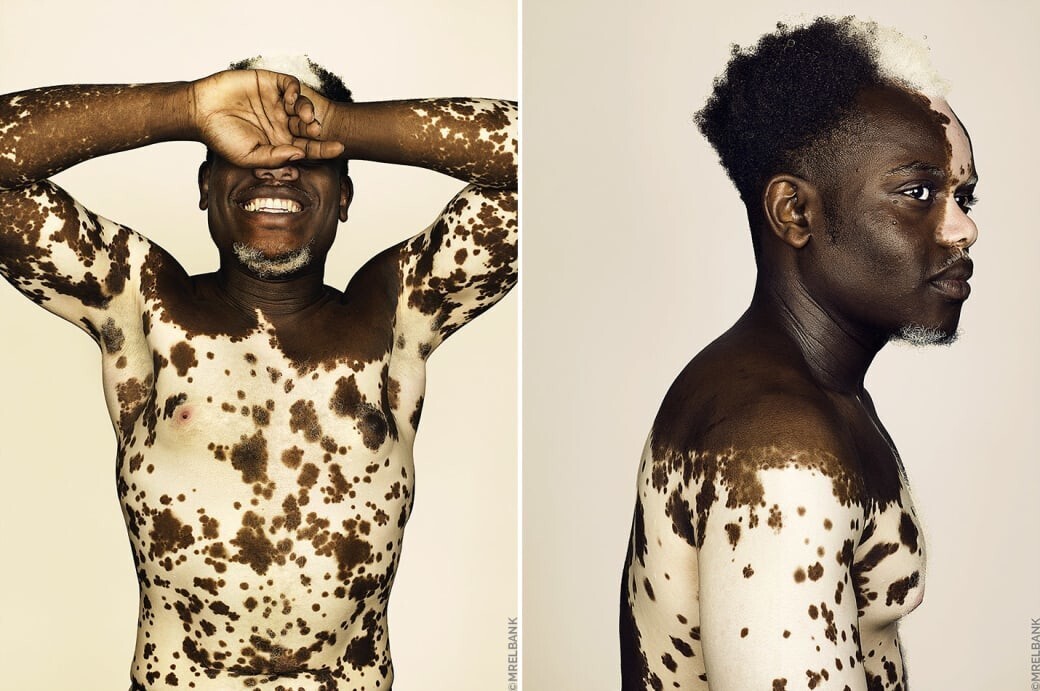 Патология, которая делает людей привлекательными, или Трагическая красота