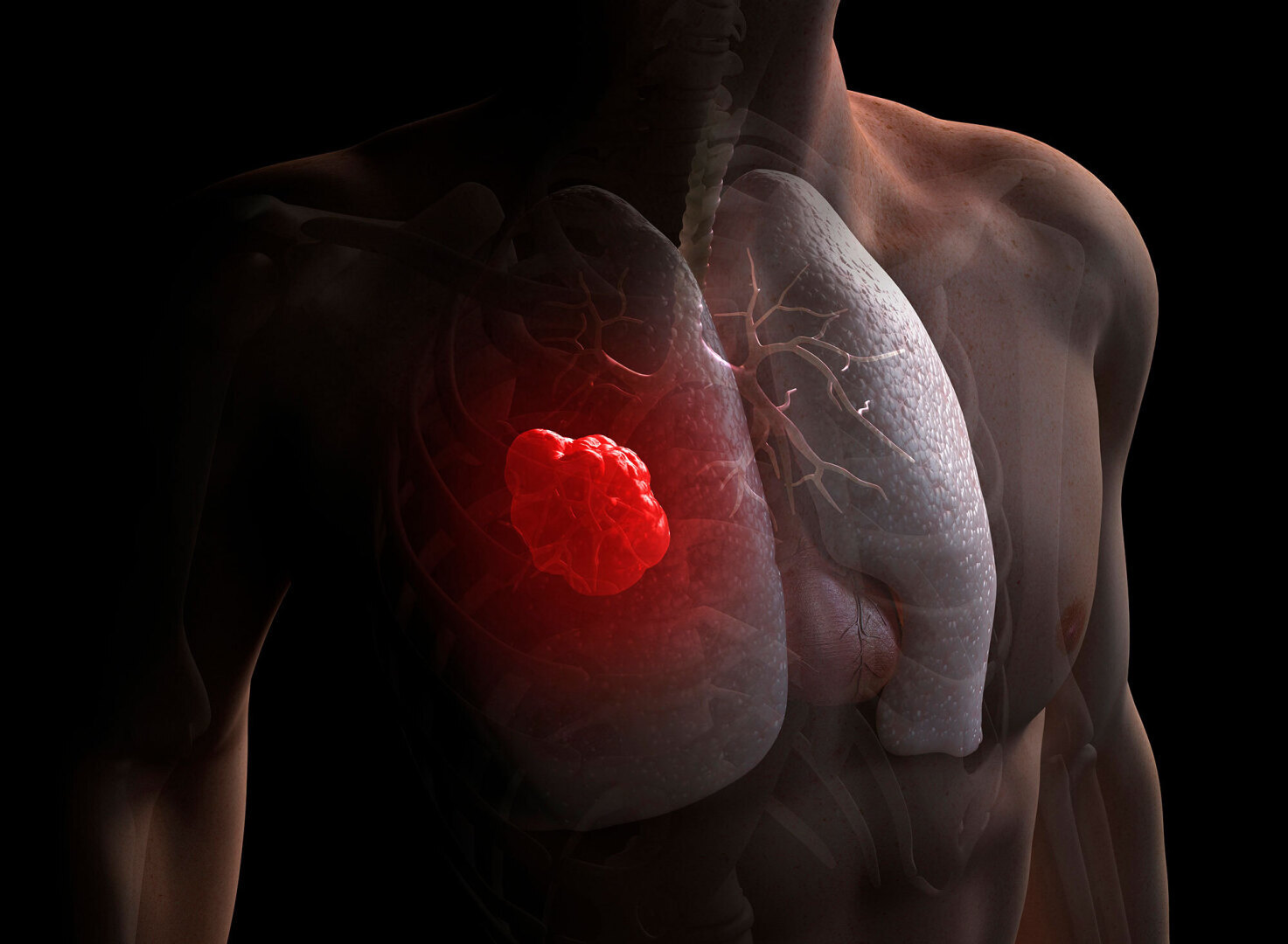 Раковые Заболевания - Всегда Страшно. Как диагностируется и лечится рак легких?