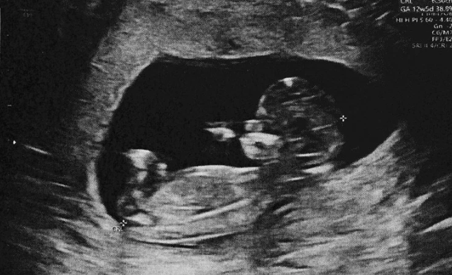 Прогнозирование аномалий почек внутриутробно с помощью глубокого обучения