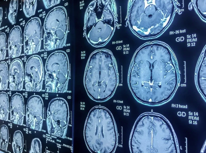 Исследование рассматривает детскую черепно-мозговую травму как потенциальный фактор риска развития психотических расстройств или симптомов