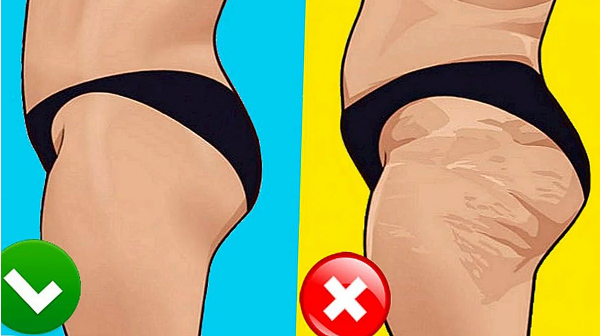 10 способов борьбы с целлюлитом естественным образом. Красота и здоровье.