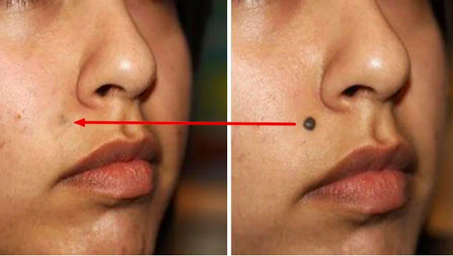 Как удалить родинки, бородавки, угри, теги кожи и возрастные пятна естественным путем.