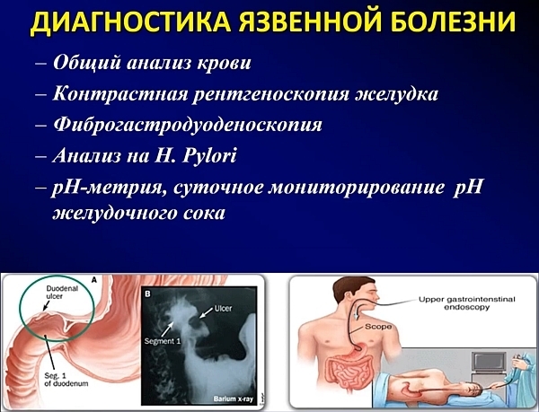 Народные средства лечения язвенной болезни желудка и двенадцатиперстной кишки.