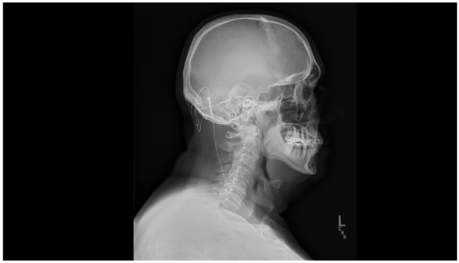 ‘Величайшее чувство в мире’: глубокая стимуляция мозга помогает человеку, пережившему инсульт, обрести независимость