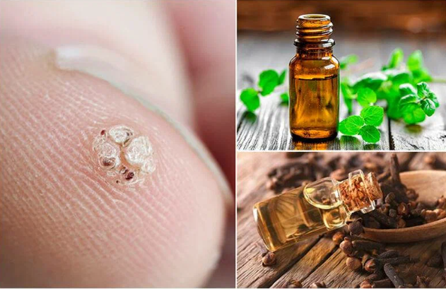 Как удалить родинки, бородавки, угри, теги кожи и возрастные пятна в домашних условиях