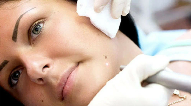 Как удалить родинки, бородавки, угри, теги кожи и возрастные пятна в домашних условиях