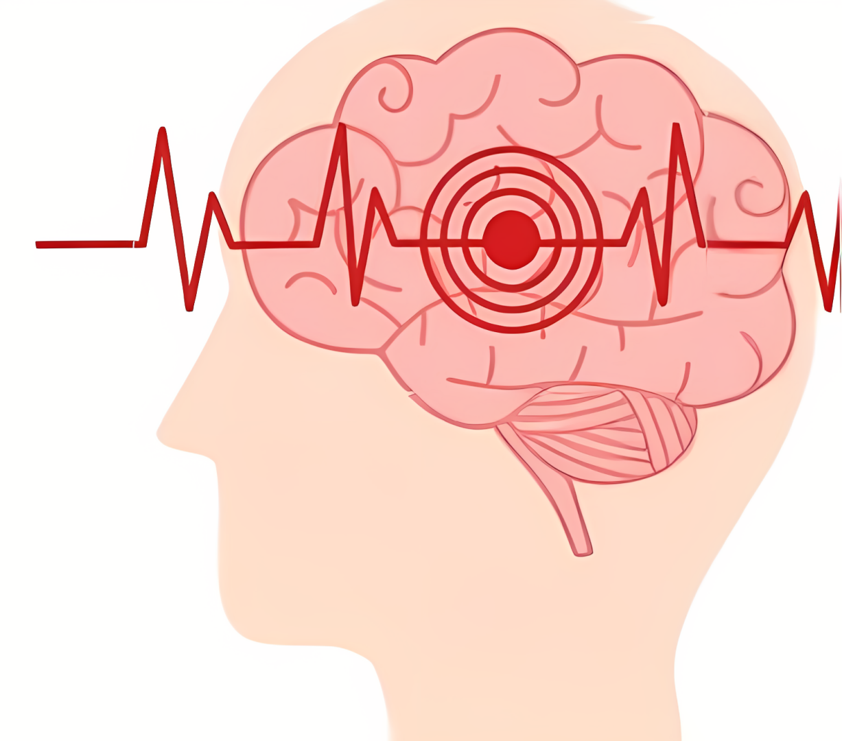 Три признака ИНСУЛЬТА.