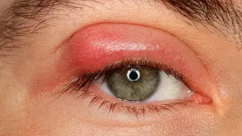 Офтальмолог объяснила, почему опасно выдавливать ячмень на глазу