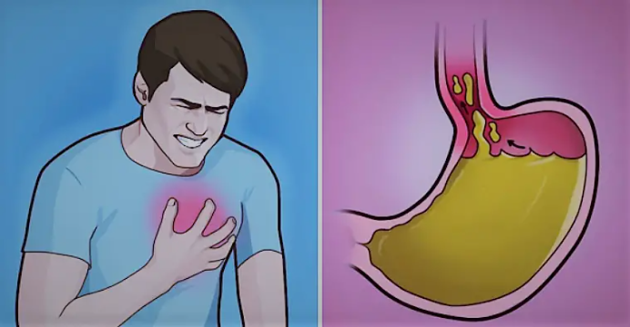Как быстро избавиться от изжоги или кислотного рефлюкса – 7 эффективных домашних средств