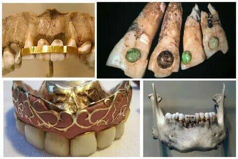 Эволюция зубных протезов: чем заменяли зубы наши предки?