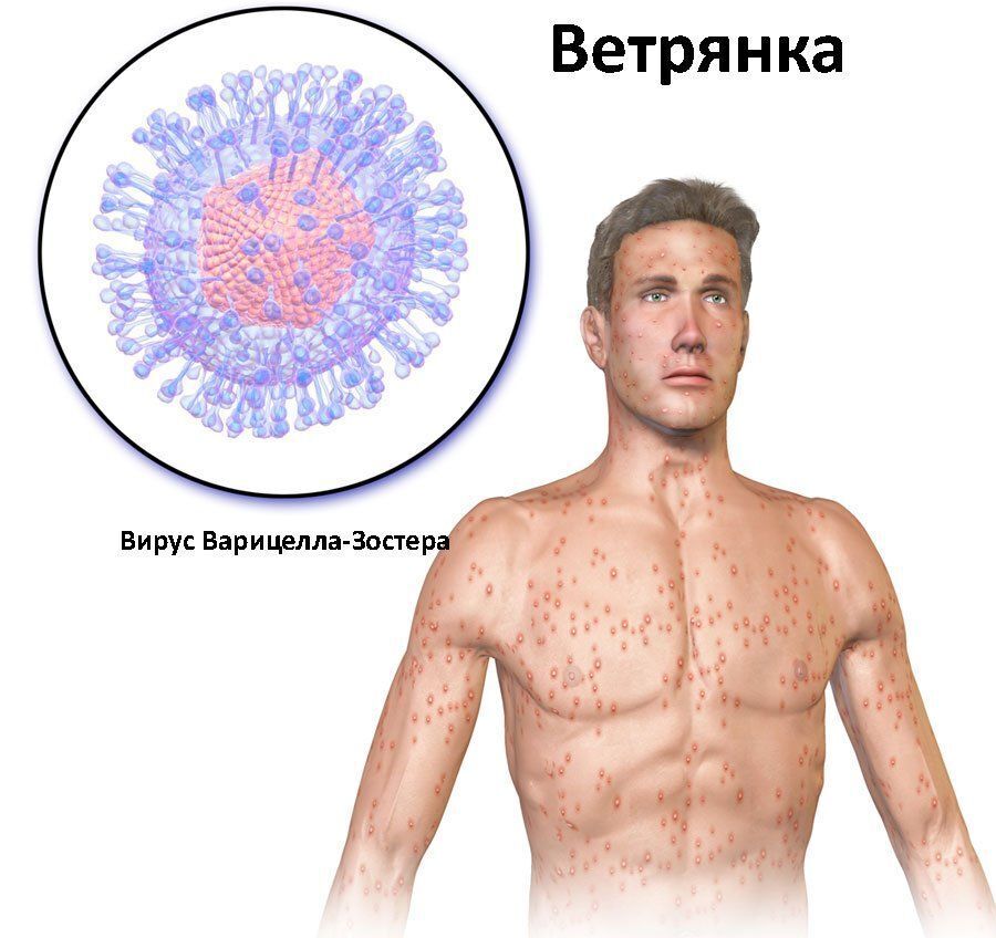 Что делать если заболел ветрянкой. Что делать, чем мазать, как лечить.