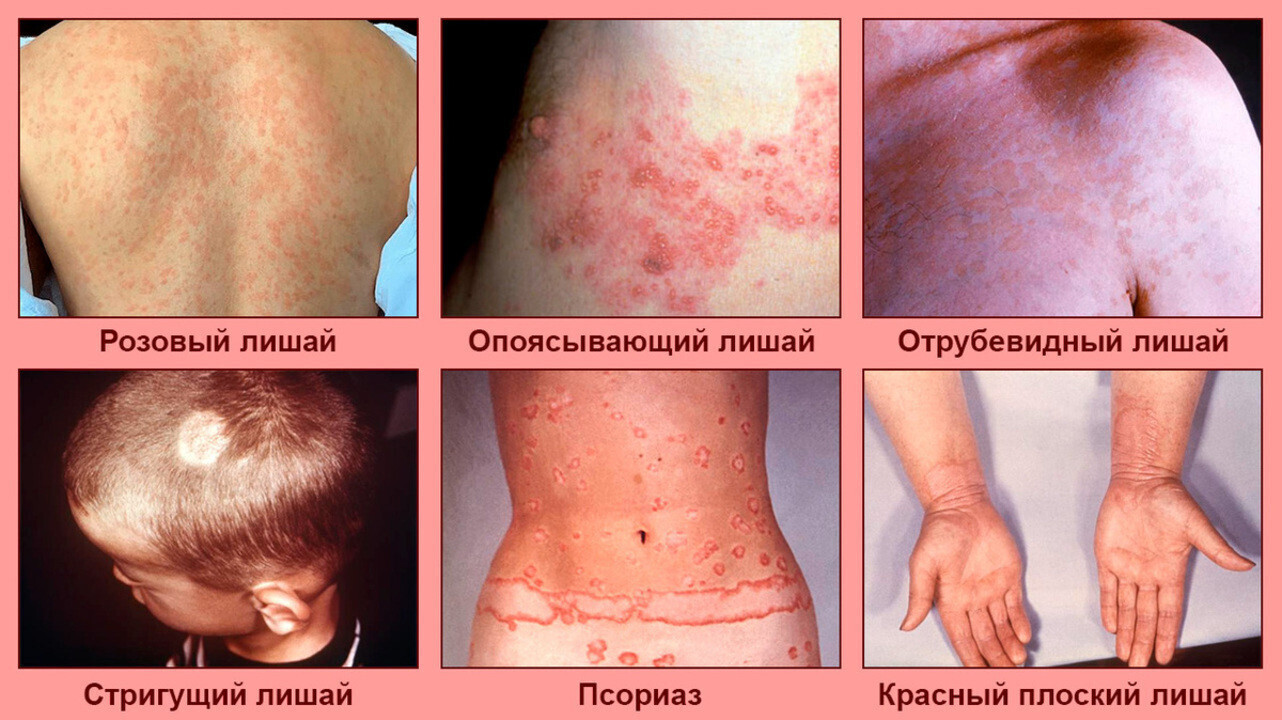 «Таинственная красота: разгадка загадки кожного лишайника»