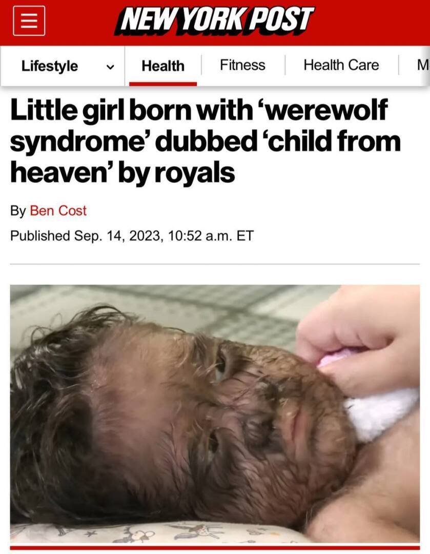 В Малайзии маленькая девочка родилась с «синдромом оборотня»