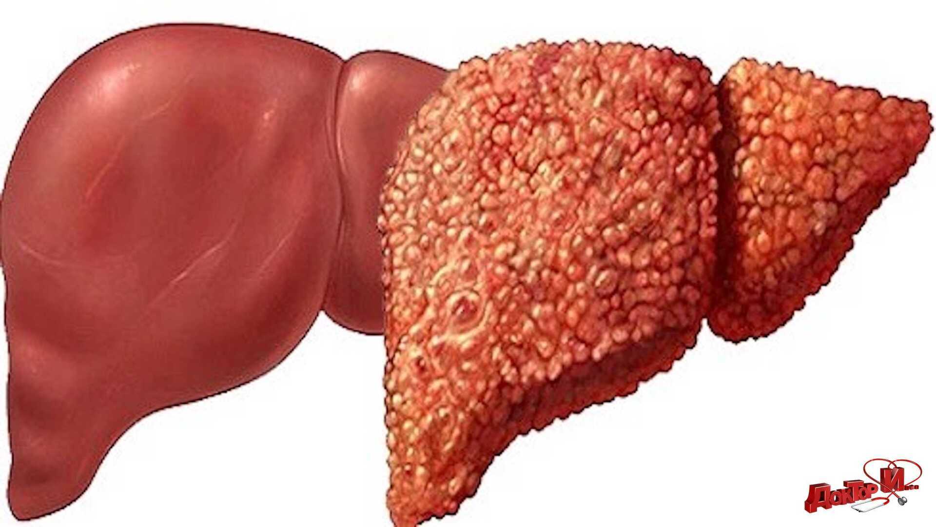 Цирроз печени: симптомы, причины и лечение