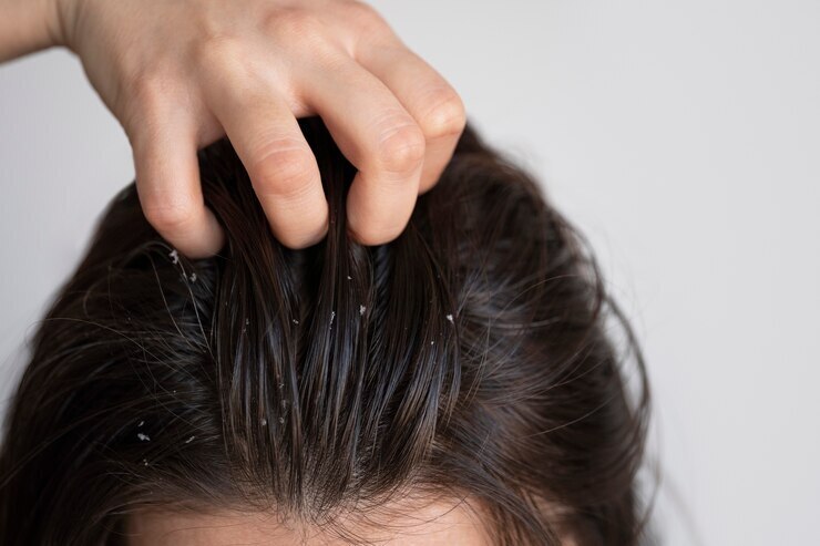 Вот несколько домашних средств, которые помогут избавиться от перхоти