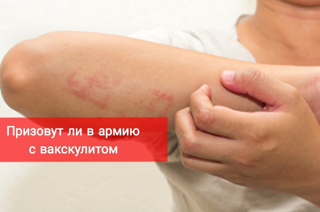 Призовут ли в армию с васкулитом