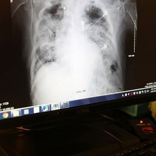 Выявлена ключевая причина развития рака у больных ВИЧ