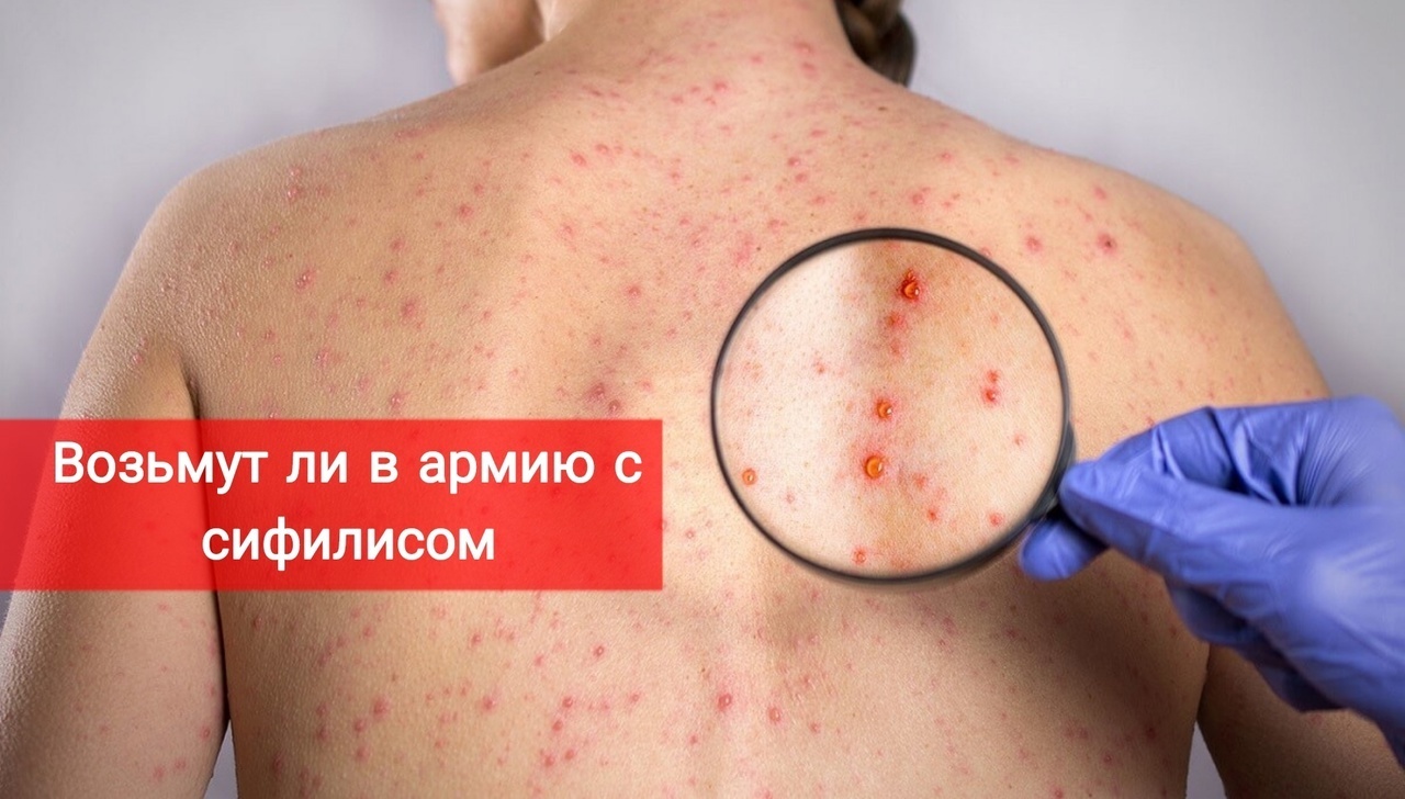 Берут ли в армию с сифилисом