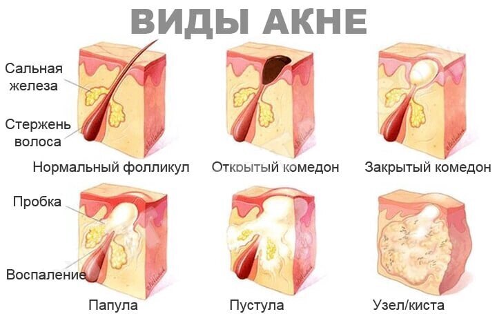 🔸 Угревая болезнь (акне), методы лечения и профилактика.