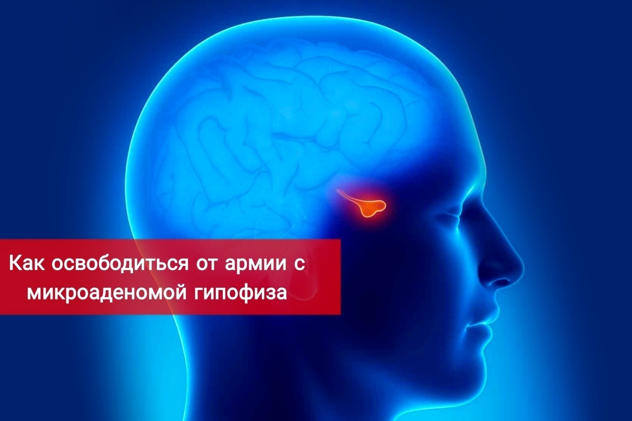 Как освободиться от армии с микроаденомой гипофиза