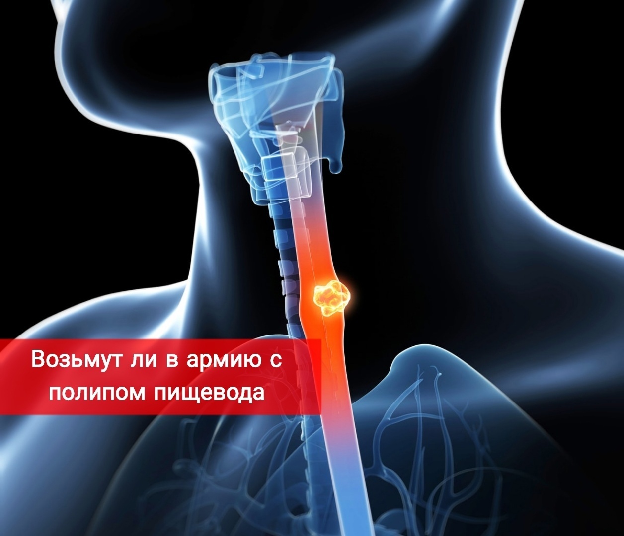 Возьмут ли в армию с полипами пищевода