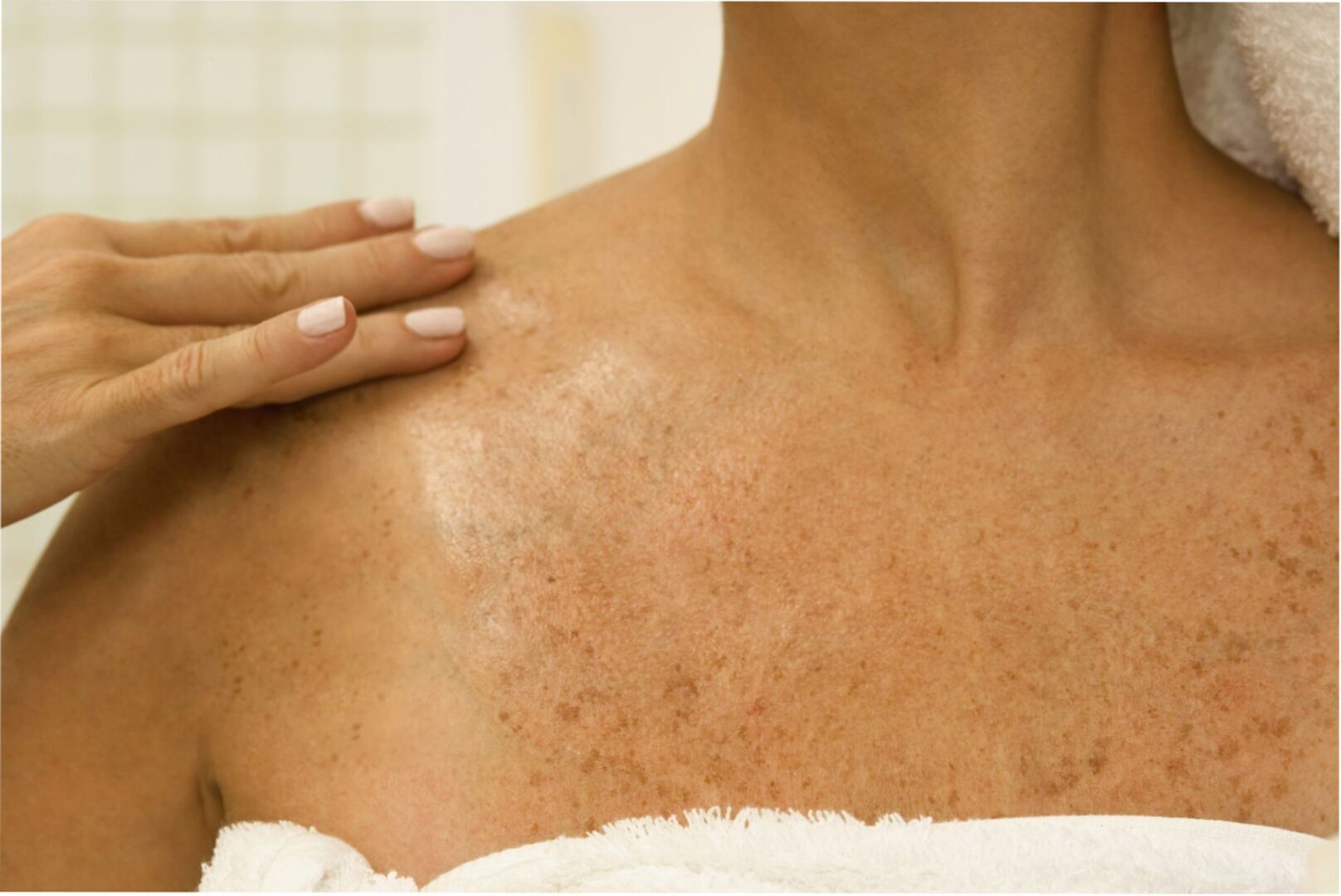 Всё что следует знать о пигментных пятнах