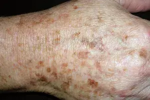 Что такое веснушки